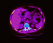 Granuloma & Calcification in Lung