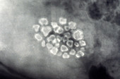 Gallstones (X-ray)
