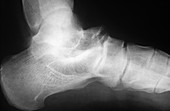 Osteomyelitis,X-ray