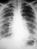 Idiopathic Pulmonary Fibrosis,X-ray