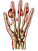 Hand with gout