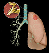 Tuberculosis with granulomas