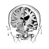 Normal Alzheimer's Brain Comparison