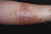 Acute Dermatitis