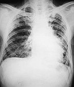 Silicosis Caused by Asbestos