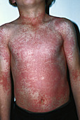 Toxic Erythema (Drug Reaction)