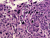 Gall Bladder Carcinoma