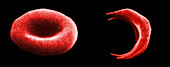 Normal and Sickle Red Blood Cells,SEM