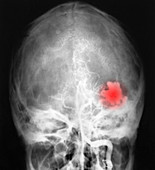 Cerebellar Angioma X-Ray