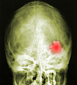 Cerebellar Angioma X-Ray