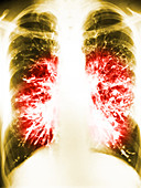 Bronchiectasis X-Ray