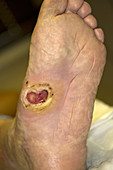 Diabetic foot Ulcer