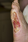 Diabetic Foot Ulcer