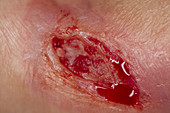 Wound after debridement