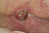 Sacral pressure ulcer Stage III