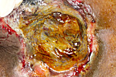 Sacral pressure ulcer stage IV