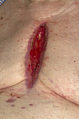 Non-healing surgical ulcer