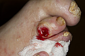 Diabetic toe wound