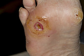 Diabetic Foot Ulcer