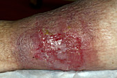 Venous Stasis Ulcer on leg