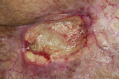 Radiation Tissue Damage