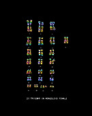 Female Karyotype showing Down's Syndrome