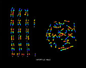 Infertile Male Karyotype