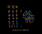 Male Karyotype showing Down's Syndrome