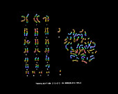 Male Karyotype showing Down's Syndrome