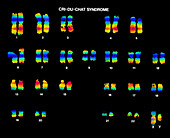 Cri-Du-Chat Syndrome