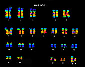 Isochromosome 21 in Male Karyotype