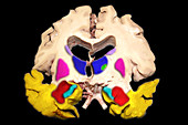 Colour Enhanced Severe Alzheimer's Diseas