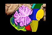 Brainstem,Cerebellum and Occipital Lobe