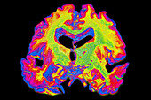 Brain with Severe Alzheimers Disease