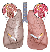 Conceptual Illustration of Emphysema