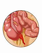 Inflamed Appendix