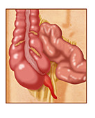 Inflamed Appendix