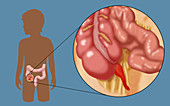 Inflamed Appendix