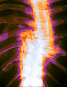Dislocated Spine,X-ray
