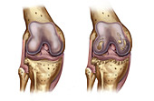 Osteoporosis of the Knee