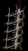 Dural Sac and Spinal Nerve Roots