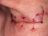 Wound Healing (3 of 4)
