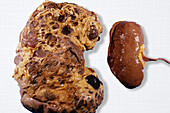 Polycystic and Normal Kidneys