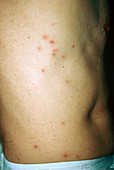 Folliculitis