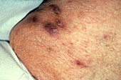 Boils on Patient's Thigh