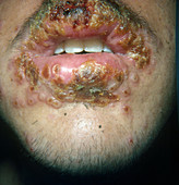 Herpes Simplex Virus type 1