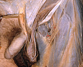 Partial Inguinal Dissection