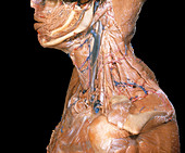 Dissected Neck