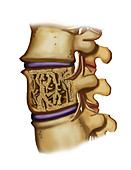 Osteoporosis Fracture in Spine