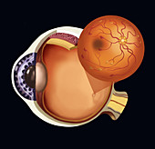 Ocular Hypertension